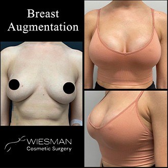 Patient before and after breast augmentation