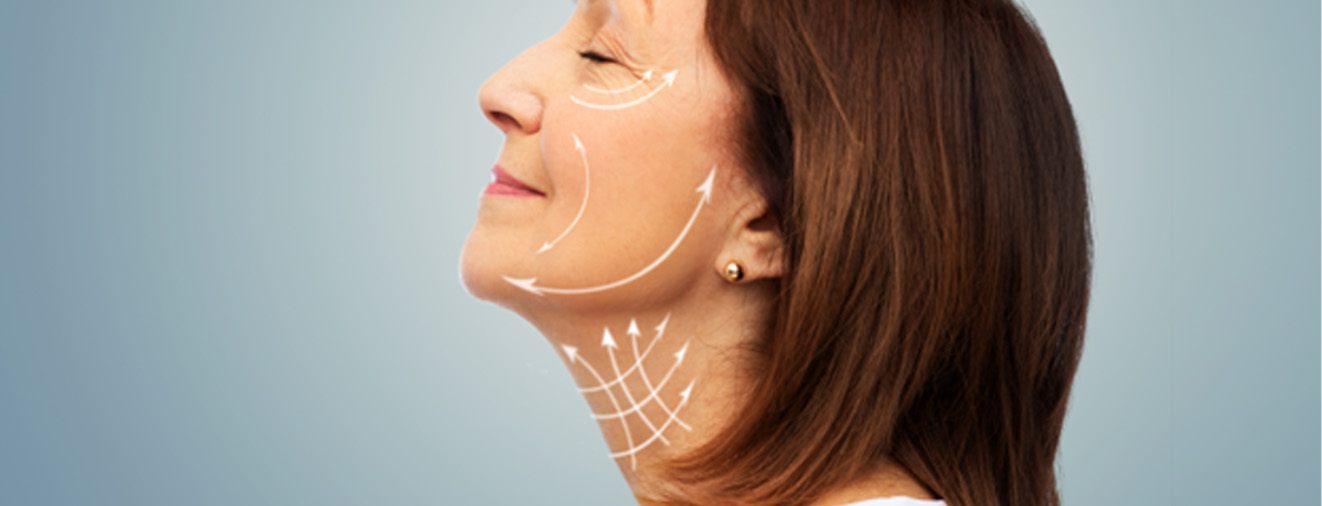 Lines on a woman’s face, showing the potential results of a facelift