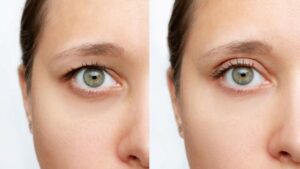 Close-up of woman’s eye before and after eyelid surgery