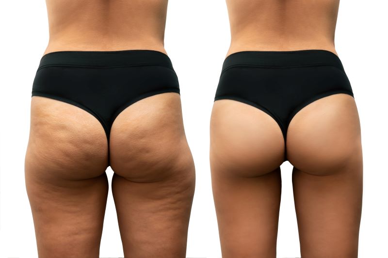 https://www.wiesmancosmeticsurgery.com/blog/wp-content/uploads/Womans-backside-before-and-after-cellulite-reduction.jpg