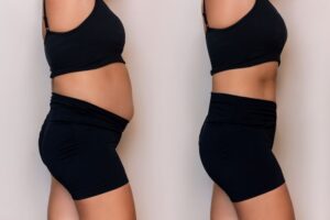 Woman’s midsection before and after fat removal procedure